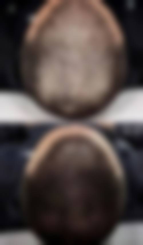 占家佳发际线调整实例