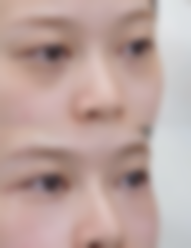 轻医美小妙招，轻松改善眼袋