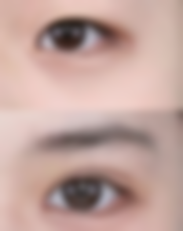 三点定位双眼皮成效能否长久？延长成效的秘诀