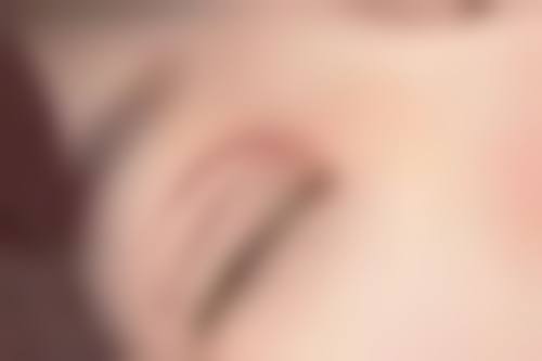 激光治疗点痣增生疤痕优势多,耐心治疗有成效