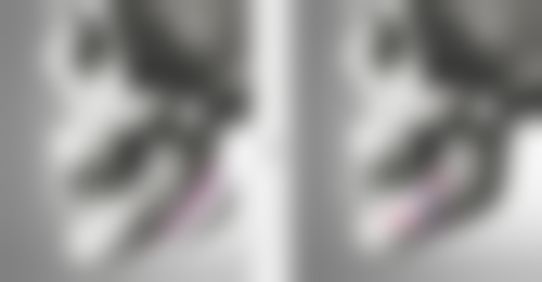 快速去掉眼袋:医院选择特别重要