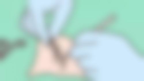 割双眼皮多久能修复自然？加速修复的小技巧