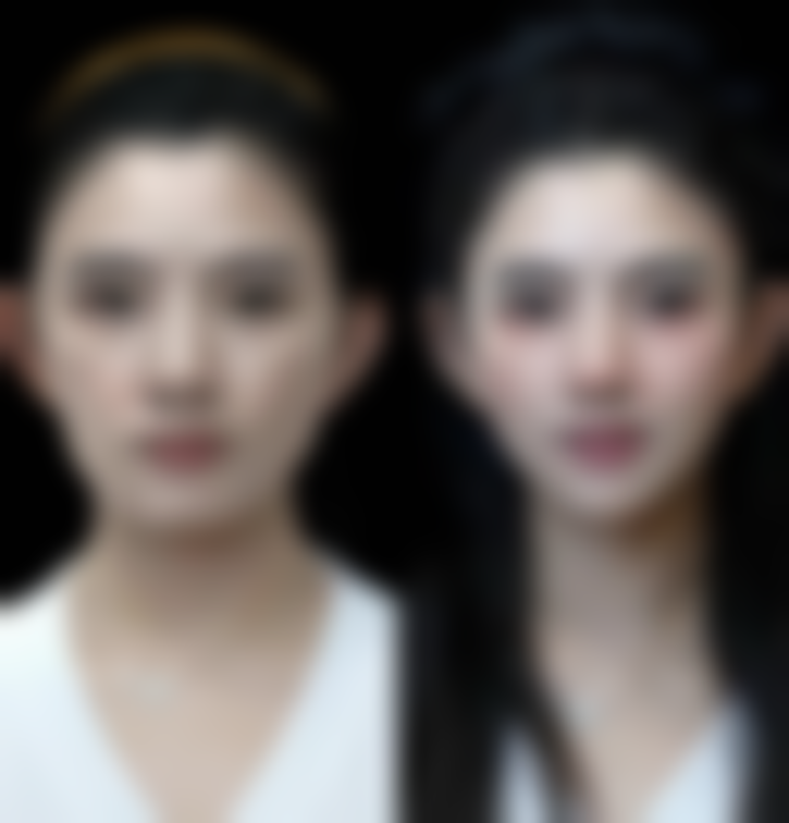 十几年烫伤疤痕如何去除？综合医美方案+个性化治疗助你淡化疤痕重塑肌肤