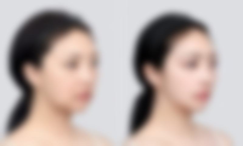 割双眼皮多久能修复自然？选择正规医院的重要性