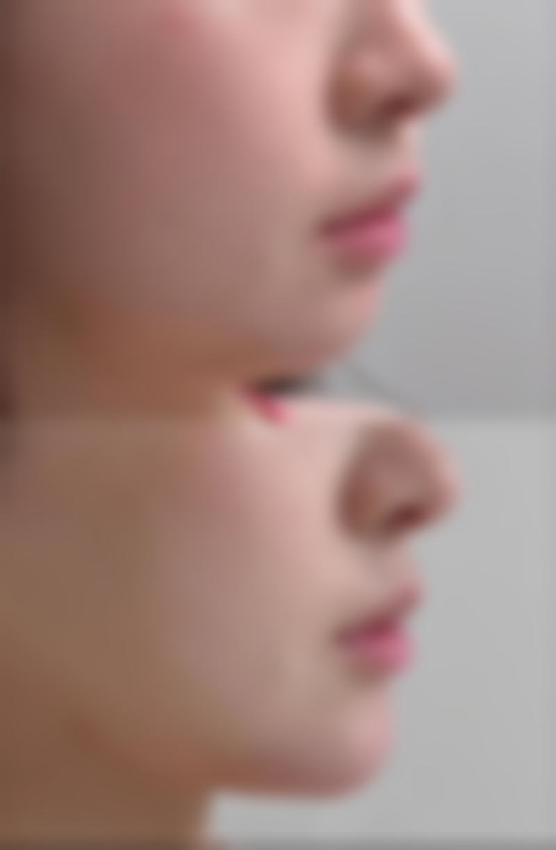 标题：凹陷疤痕的修复方法

治疗凹陷性疤痕的方法通常是通过手术或激光等手段来改善，如凹陷疤痕修复的关键在于通过手术或激光治疗来修复凹陷，从而达到去除疤痕的目的。

因此，标题为“凹陷疤痕修复”。

需要注意的是，标题中的“凹陷疤痕”是指因各种原因导致的疤痕，如痤疮、疤痕疙瘩、凹陷疤痕、增生性疤痕、疤痕疙瘩、疤痕疙瘩、凹陷疤痕、增生性疤痕、凹陷疤痕、增生性疤痕、凹陷疤痕、增生性疤痕。

标题中的“凹陷疤痕”是指因各种原因导致的疤痕，如痤疮、疤痕疙瘩，通常是由于皮肤的新陈代谢，会出现皮肤损伤、破裂，导致皮肤组