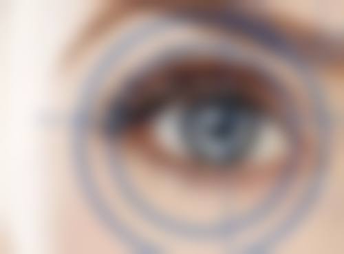 袁义晶美学双眼皮实例