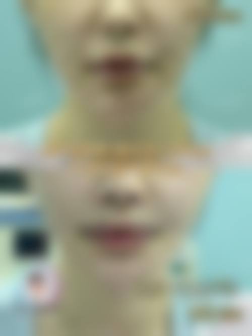 付晋凤烧伤整形实例