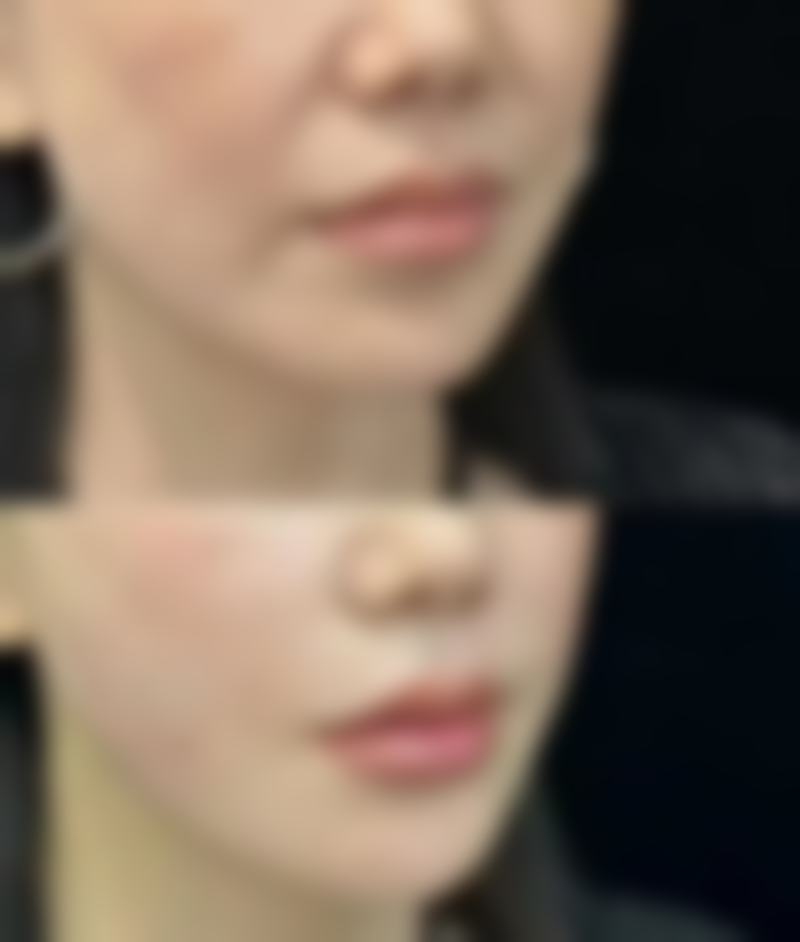 如何告别疤痕黑色困扰？多种医学手段结合科学护理，淡化去除一步到位！ 