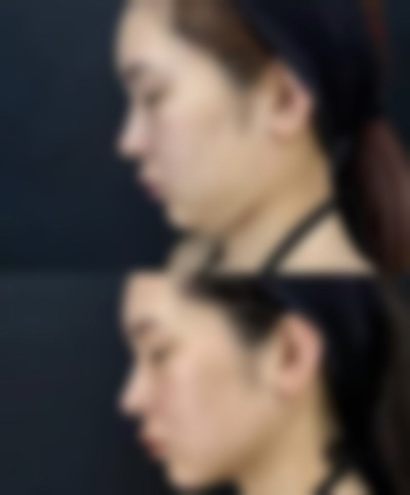 内窥镜隆胸成效显著？创伤小修复快优势揭秘