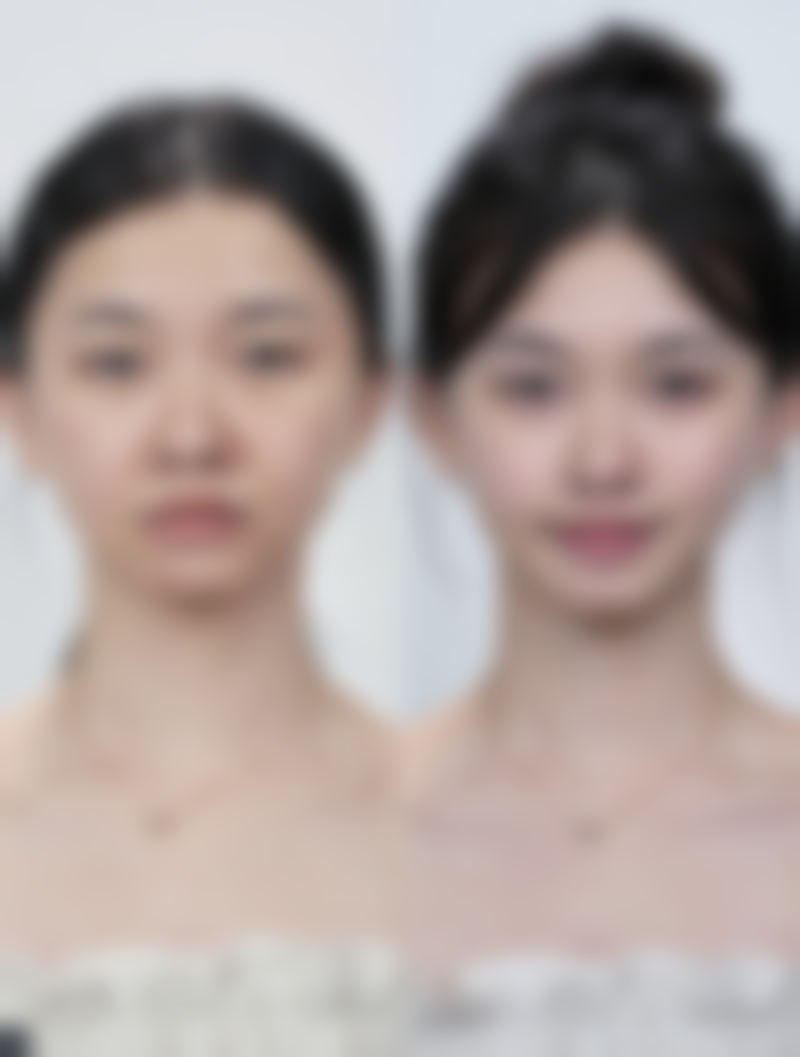 线提升隆鼻吸收时间揭秘：优势多多值得选