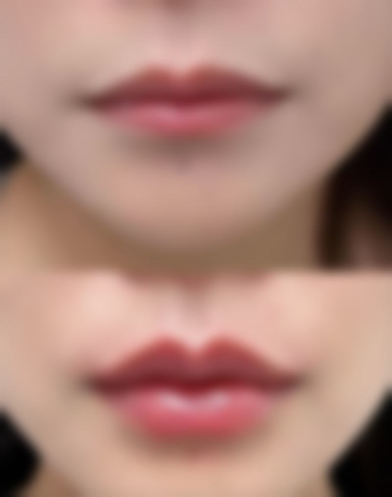 如何实现理想祛疤？保持健康生活方式