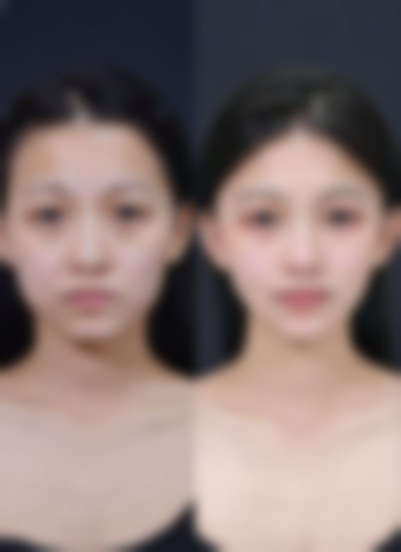 如何摆脱黑疤阴影？常见医学改善方法大揭秘