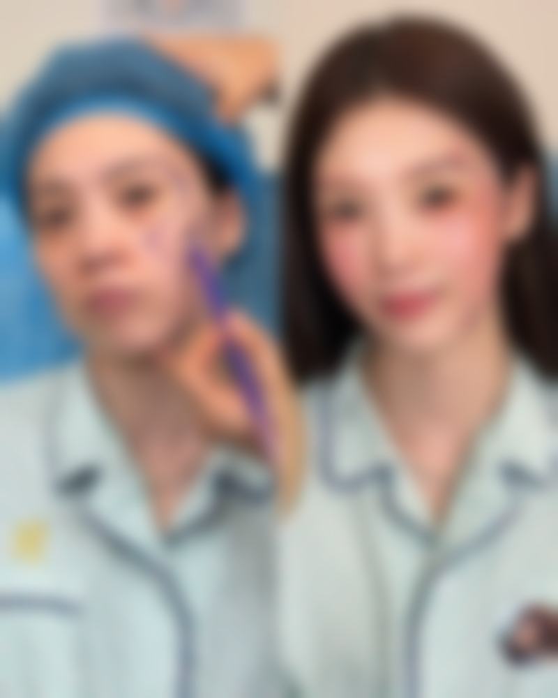 线提升隆鼻吸收时间揭秘：护理好坏左右吸收