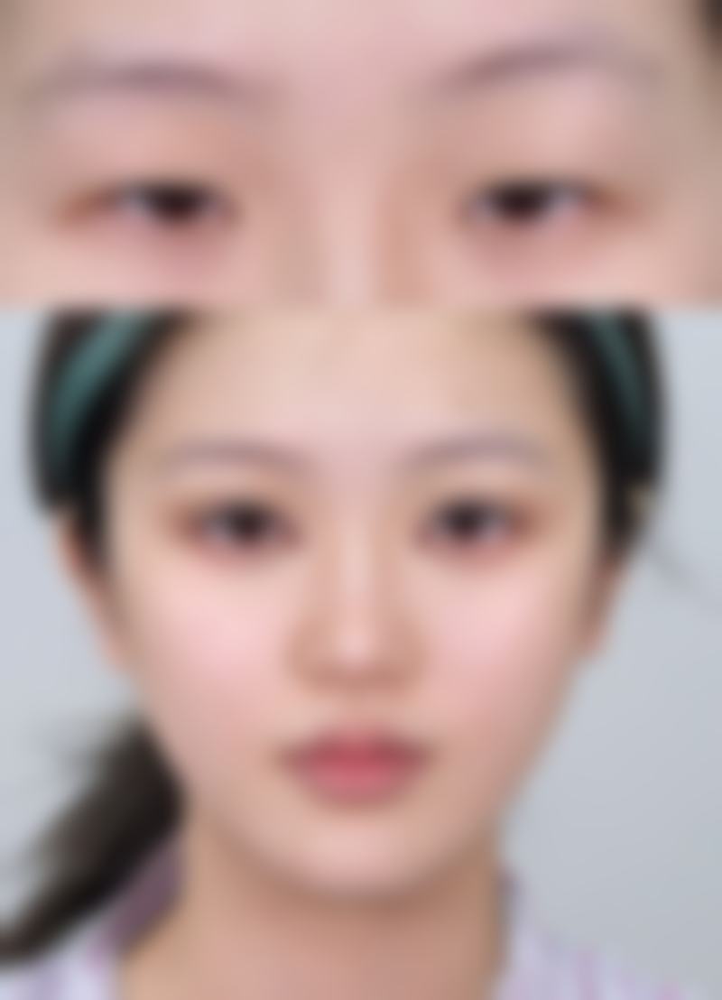 双眼皮二次修复的美学设计要点