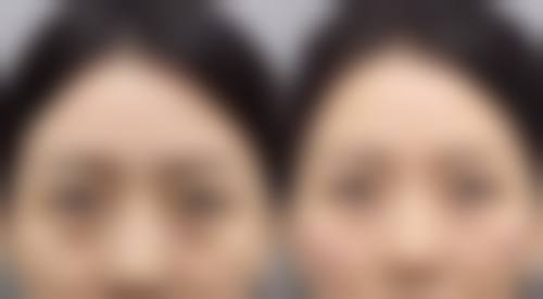 种植发毛囊不够，还有啥解决办法？