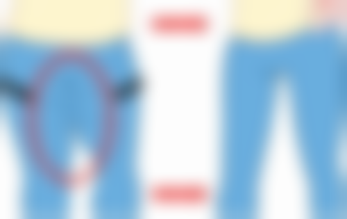 选择医院医生特别关键，保护微创双眼皮成效