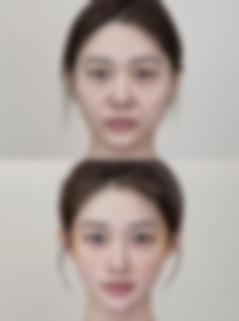 微创双眼皮并非永久，效果可维持数年，适合眼皮薄、无松弛的年轻人群 