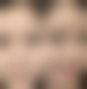 种植发毛囊不够，其他部位毛发能移植不？