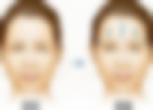 热玛吉眼部除皱：选择正规医院特别重要