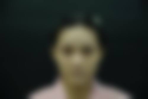 高秋珍鼻综合手术实例