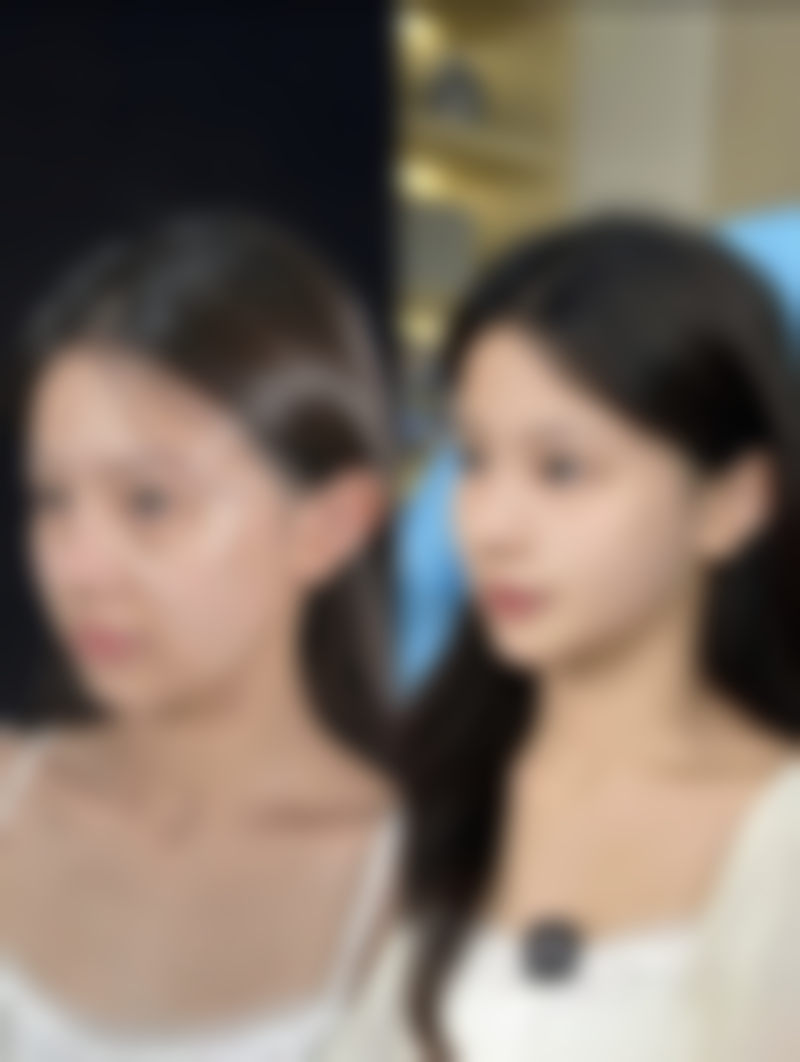 热玛吉眼部除皱：与其他方法对比优势明显