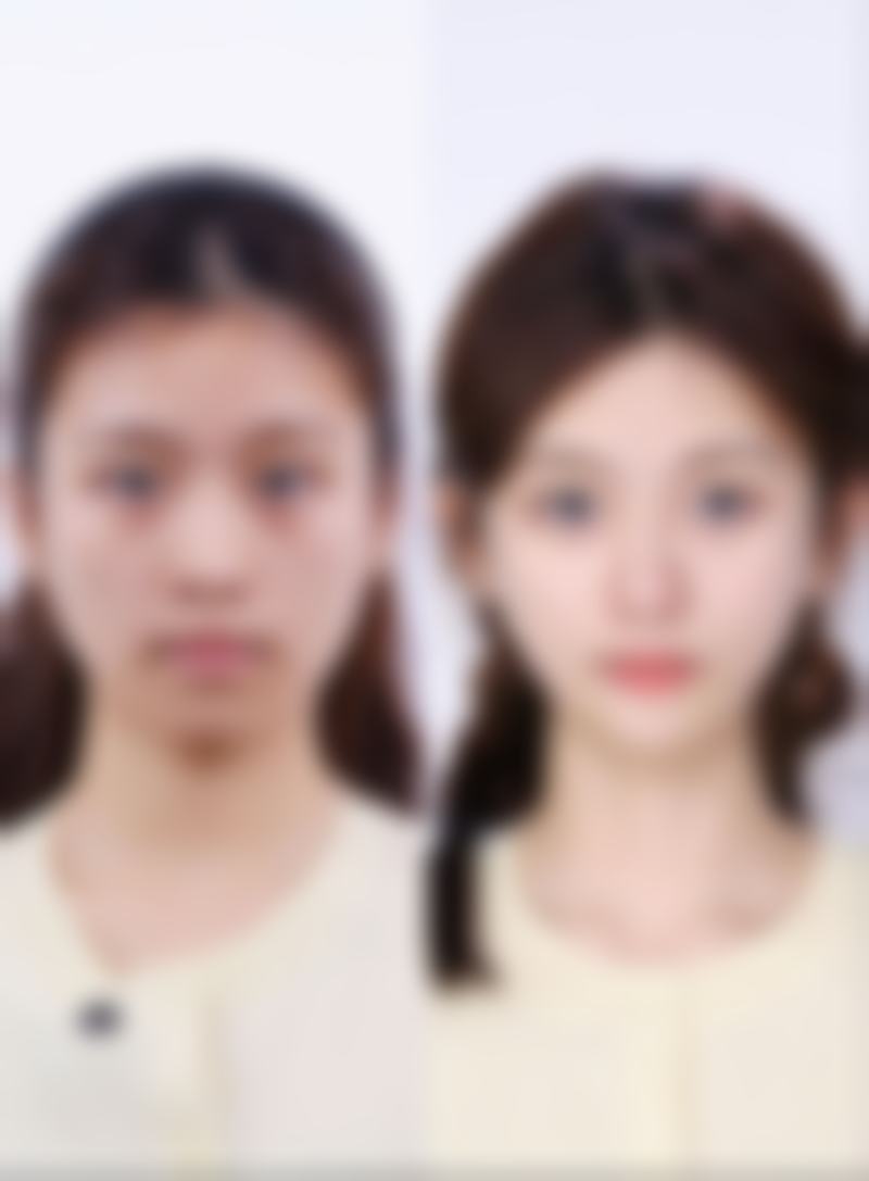 胡瑾面部美容实例