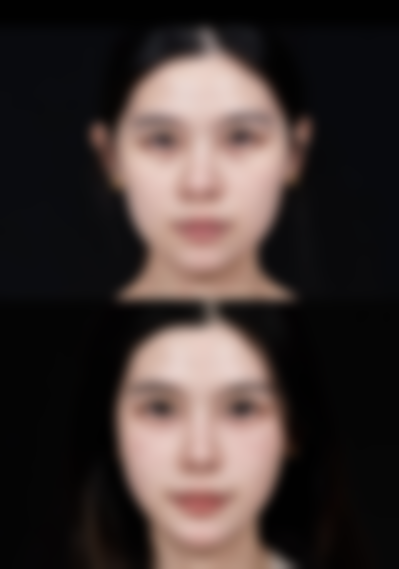 手术过程和术后护理要注意啥？对时长有影响不？