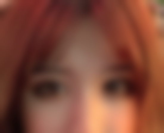 我这个单眼星人在重庆松山做眼综合 术后一月双眼对称仅花6800元