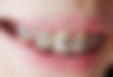 海口爱牙口腔医院矫正牙齿:价格合理且口碑好