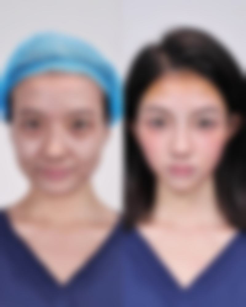 延长瘦脸针成效的秘诀