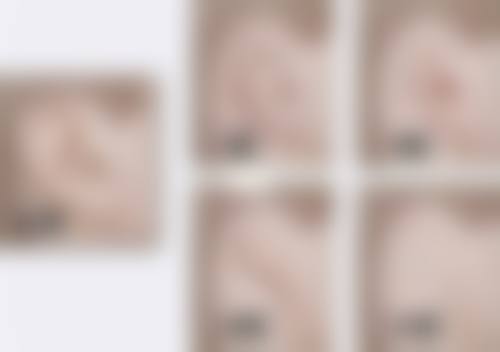 苏开新医生瘢痕防治实例