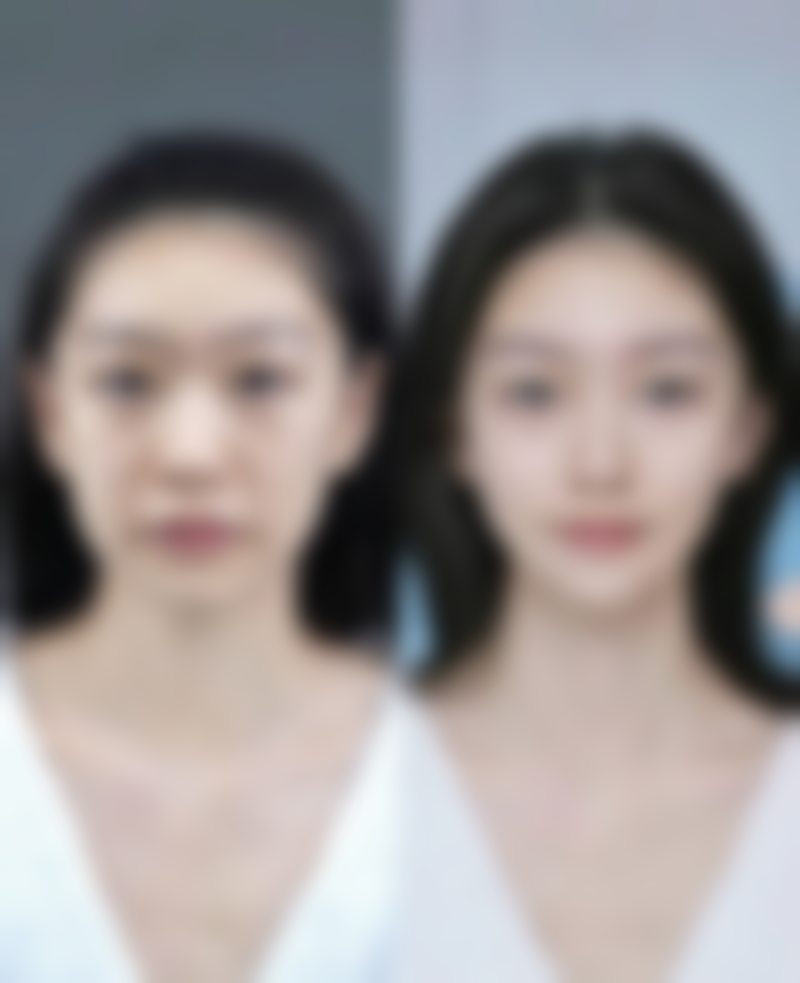 面部青春痘疤痕怎么治疗？激光治疗应对大疤痕