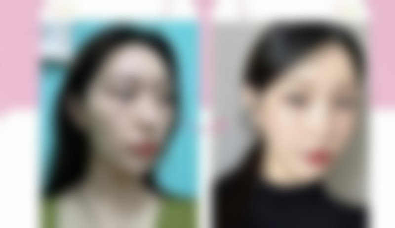 丰太阳穴风险知多少？正规操作、术后护理双保障，降低风险实现长久饱满效果 