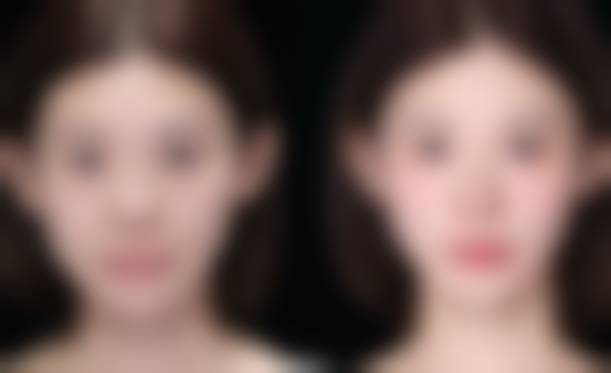 怎样安心丰太阳穴？术后护理的要点