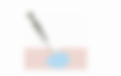 蛋白线隆鼻成效能维持多久？手术技术不可忽视