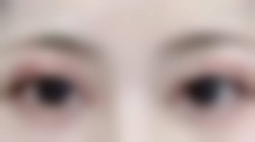 有眼袋黑眼圈别愁,综合调理更有效