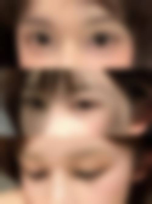 方明松医生双眼皮手术怎么样可靠吗？