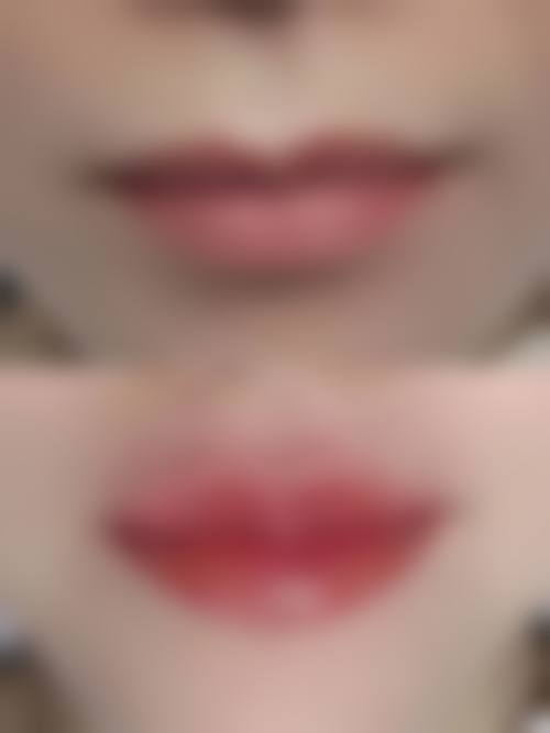 四、长沙米琪甄美整形医院实例