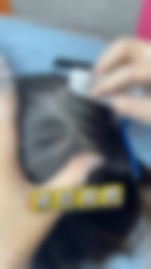 宋振宁医生毛发移植实例