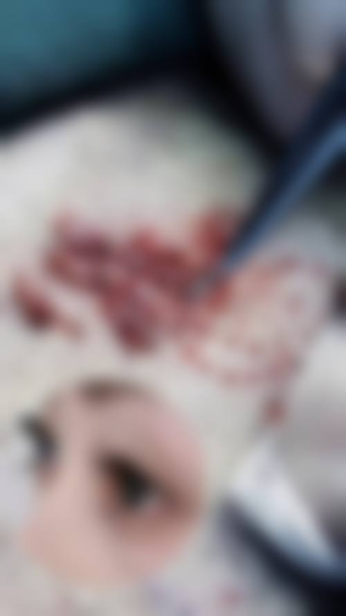 宋振宁医生毛发移植项目价格表参考