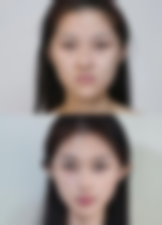 有眼袋黑眼圈别怕,物理治疗显神通