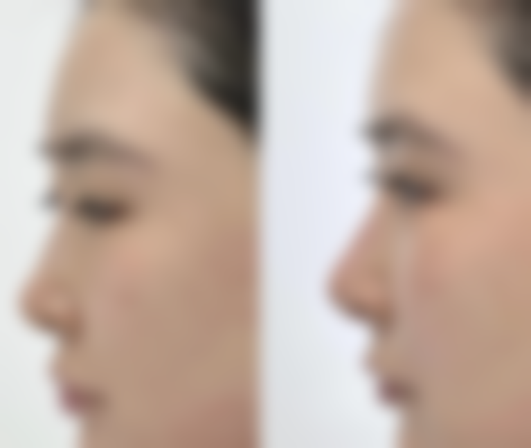 腰腹抽脂暗藏哪些伤害？出血与血肿问题别忽视