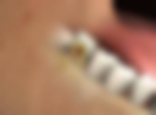 外切眼袋冰敷有啥用？收缩血管、消肿止痛，术后72小时内缓解不适就靠它！ 