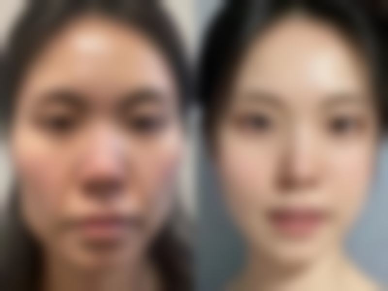 最近单眼皮变双眼皮意味着啥？应对建议与注意事项