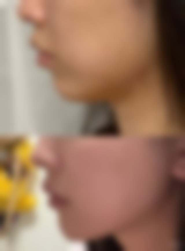 外切眼袋冰敷：操作简单，轻松实现术后护理