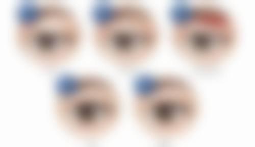 隆鼻子后可能有哪些后遗症？术后外观差、假体移位等问题需提前知晓 