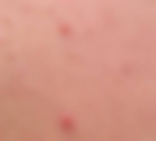 四、宁波皮肤病专科医院开展的主要项目和特色项目：