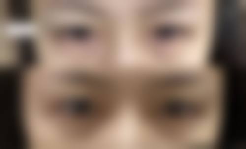 怎样快速消除熬夜眼袋？医疗干预显神通