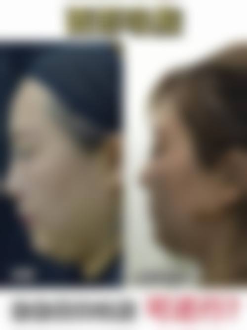 胡瑾医生面部美容实例