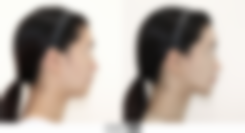 怎样快速消掉熬夜的眼袋？作息、理疗、医美多管齐下，还你明亮双眸